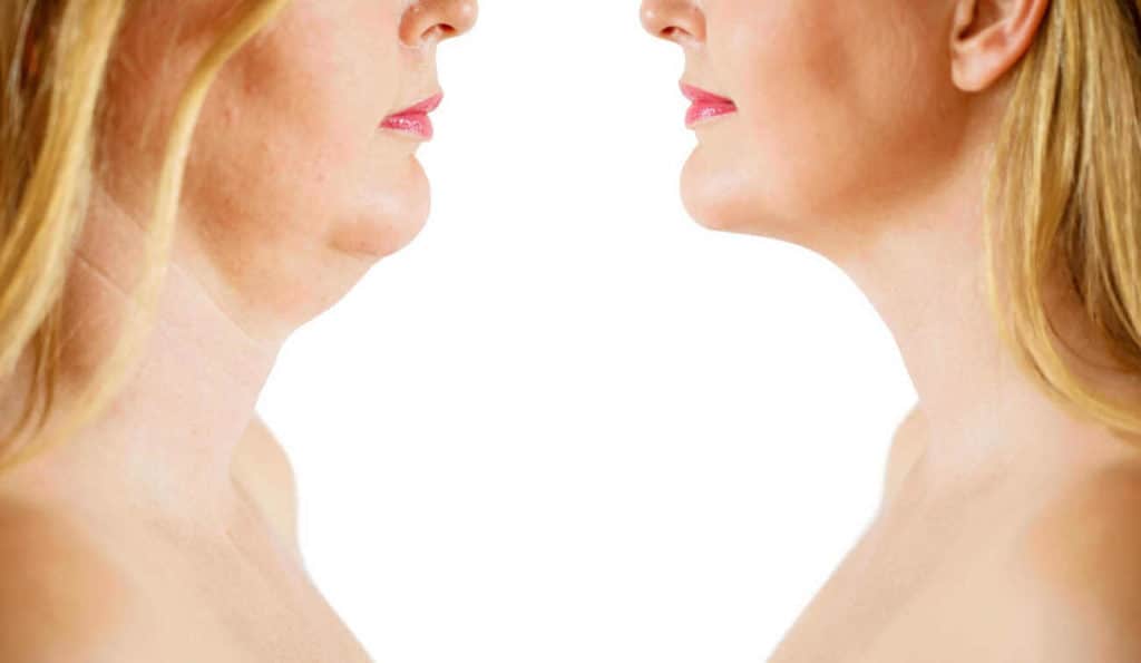 Double Chin treatment Poole before and after results