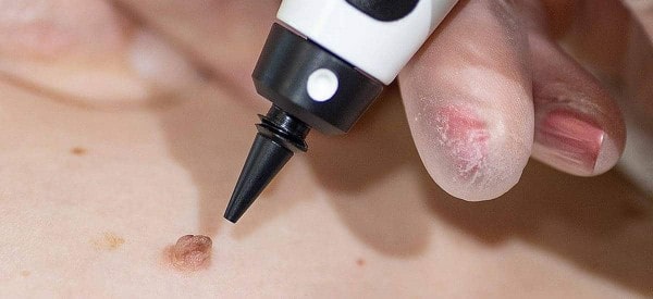 After Skin Tag Removal Poole