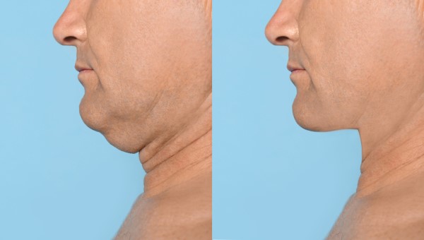Which Non-Surgical Treatments Work Best for Jowls and Loose Skin Poole?