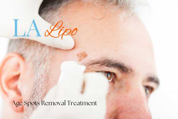 What Are the Most Effective Treatments for Age Spots Poole?