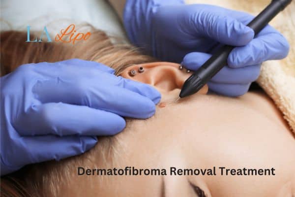 Dermatofibroma Removal Treatment Poole