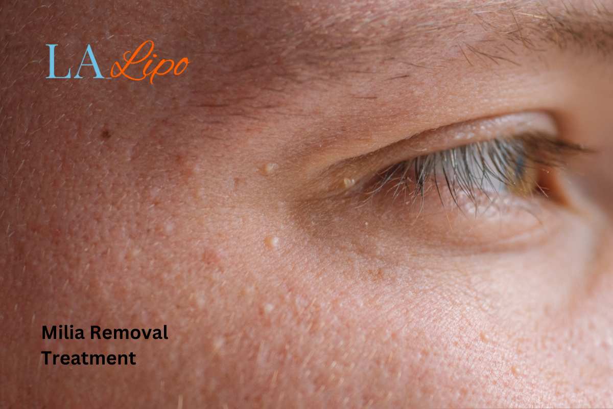 Cryopen Milia Removal: Is It the Easiest and Safest Option Poole?