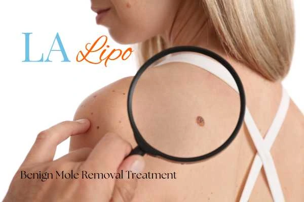 Woman having her inspection of blemish before mole removal Poole