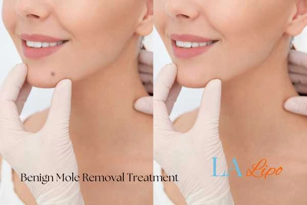 woman's before and after mole removal Poole results