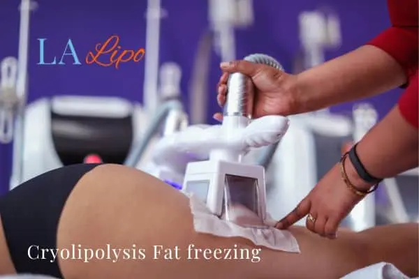 women getting fat freezing Poole
