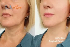 hi-fu for wrinkles Poole before and after results