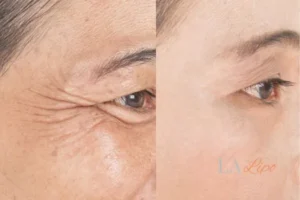 Before and after results of woman - HI-fu wrinkles reduction treatment Poole