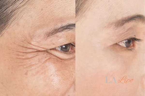 Before and after results of woman - HI-fu wrinkles reduction treatment Poole