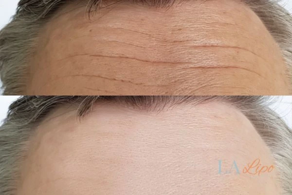 results of HIFU Poole on mans forehead to help reduce lines and wrinkles
