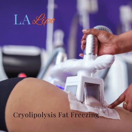 fat freezing - Cryolipolysis Poole