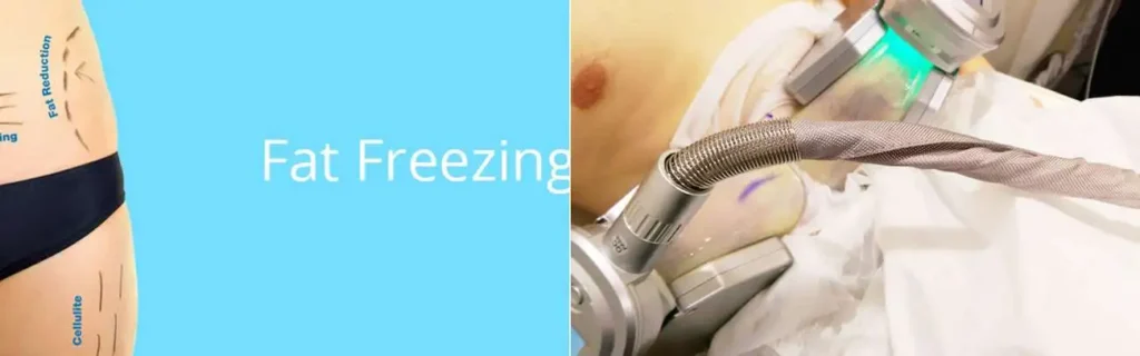 multi areas of a persons body having coolsculpting Poole treatment