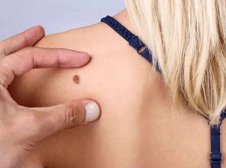 woman having mole removal Poole consultation before treatment.