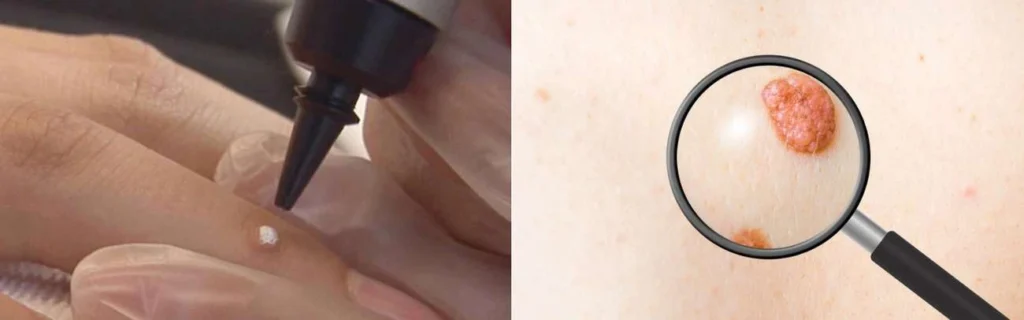 Person getting moles removed with cryopen Poole