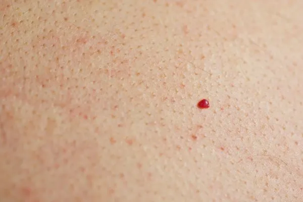 close up of a cherry angioma Poole
