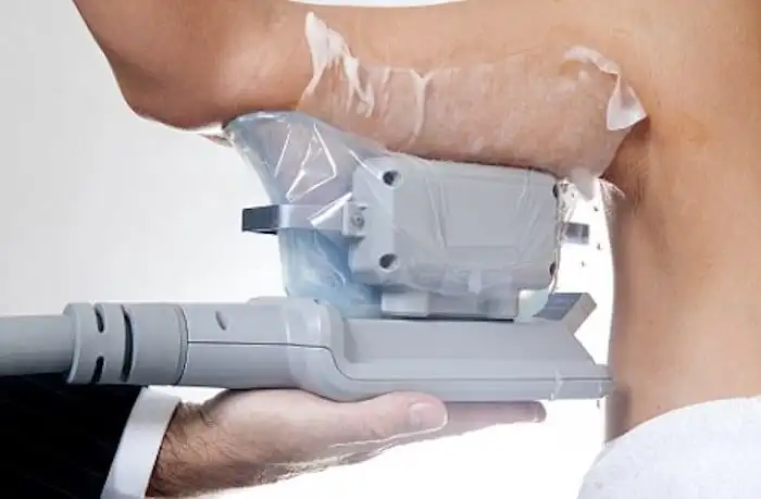 Picture of fat freezing Poole on the upper arms.