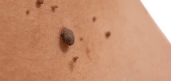 image of a skin tag Poole