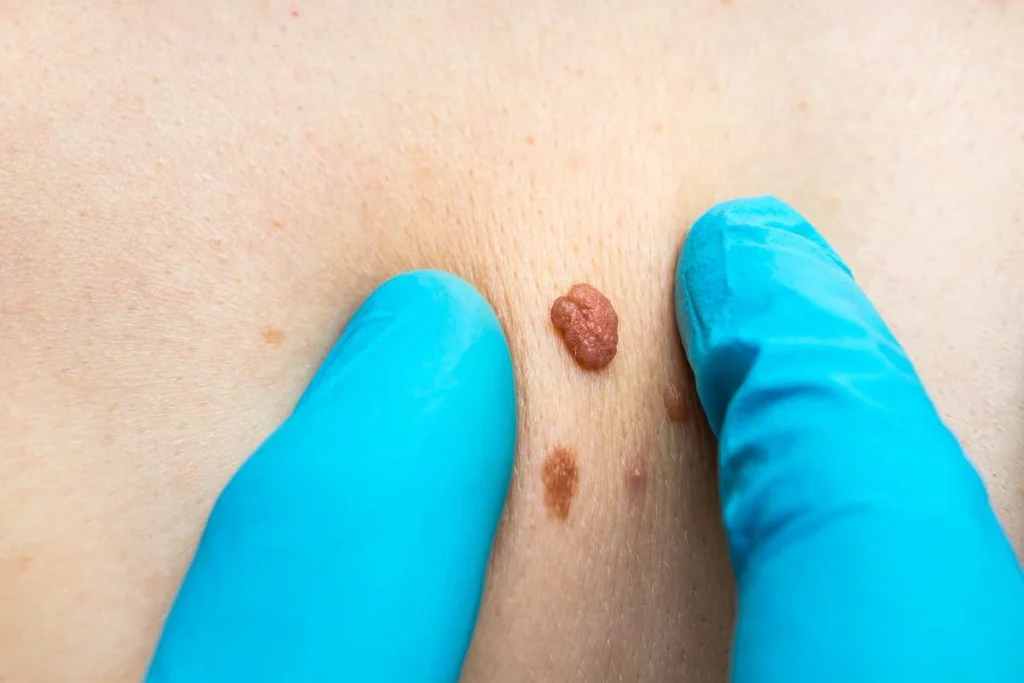 Consultant examining a skin tag Poole