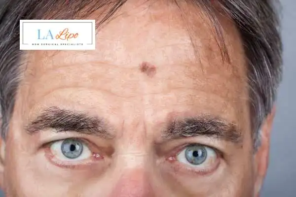 Solar Lentigo Removal Poole image of man with mark on his forehead