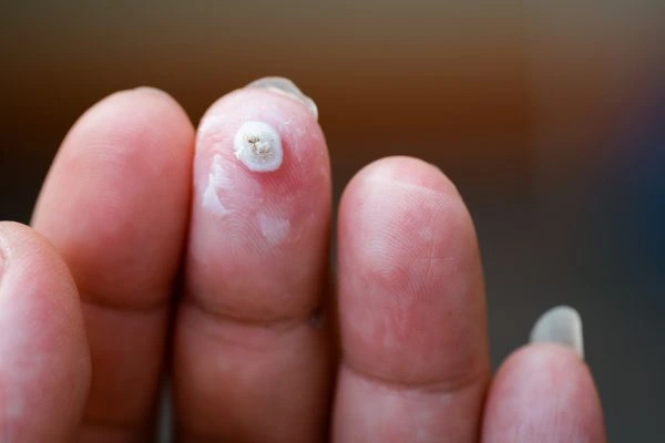 wart on person finger - cryotherapy to treat from LA LIPO Poole