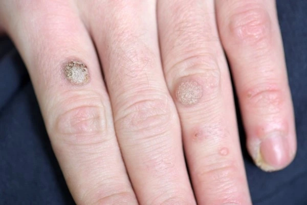 photo of warts on person hand - see wart removal Poole from LA LIPO