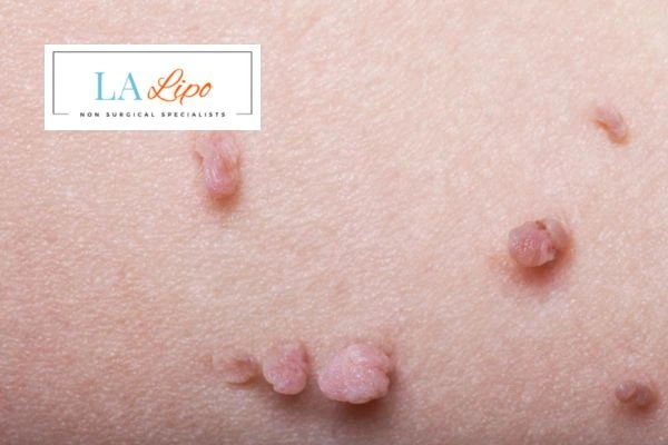 Does cryopen skin tag removal Poole hurt? Find out now call our team today!