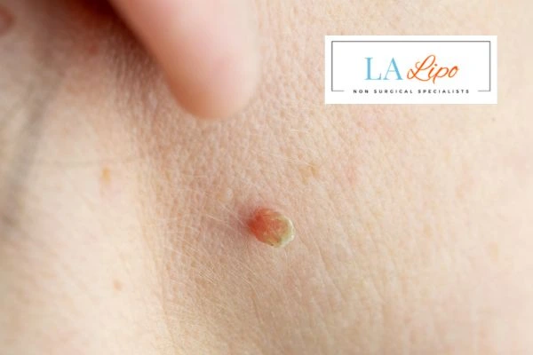 Book skin tag removal Poole today speak to our team now!