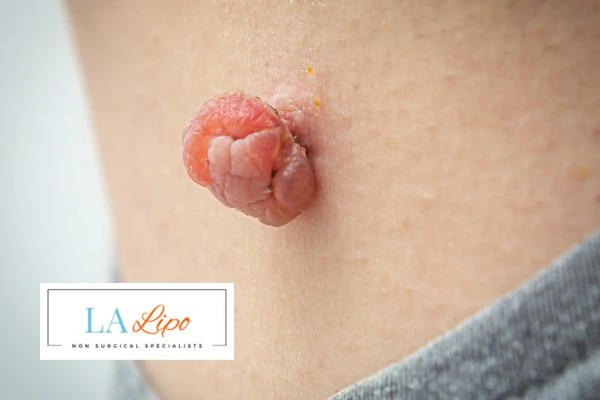 Interested in skin tag removal Poole? Concerned about the pain? Find out more today!