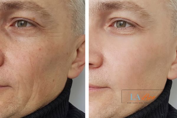 See the amazing results of Morpheus8 Treatment Poole!