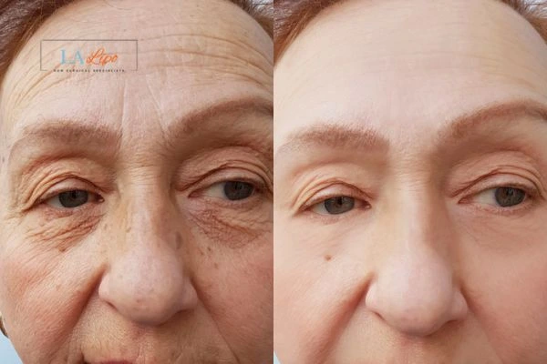 The powerful benefits of Morpheus8 Treatment Poole - Call Our team today!