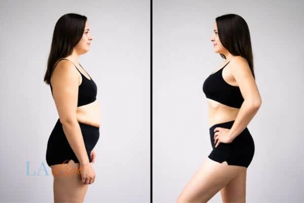 Picture of womans before and after using LA-EMS body sculpting to improve her core strength Poole