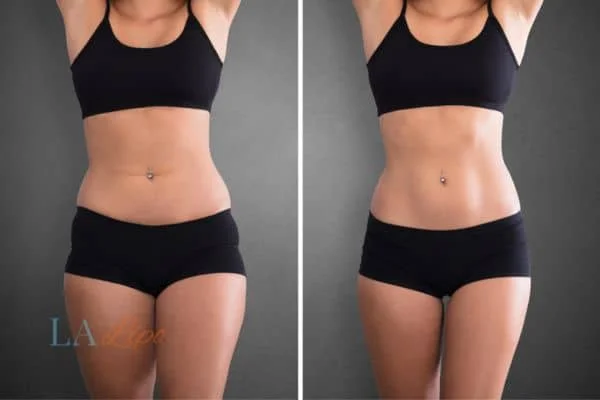 before and after results of non-surgical treatment to help a woman's body image and mental health Poole