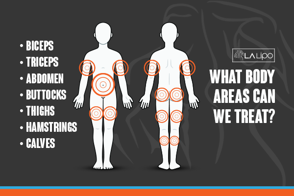 Diagram to show areas you can have LA-EMS Body Sculpting Treatment Poole