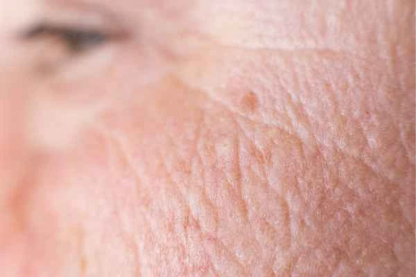 close up picture of a woman's face showing an age spot Poole