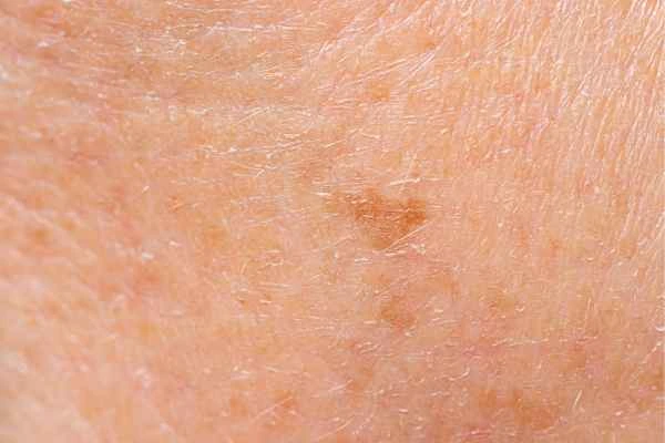 close up picture of age spots Poole