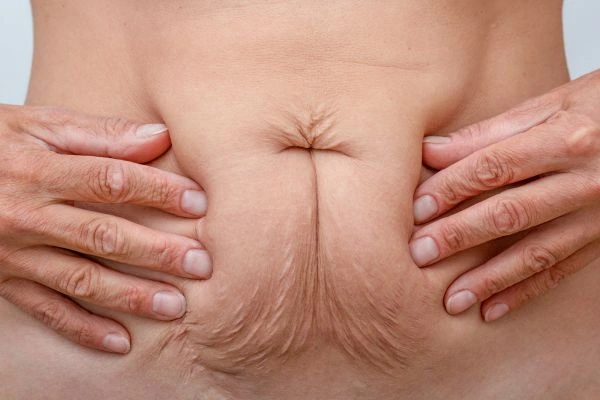 Image of a woman's stomach with loose skin - example of skin tightening Poole options