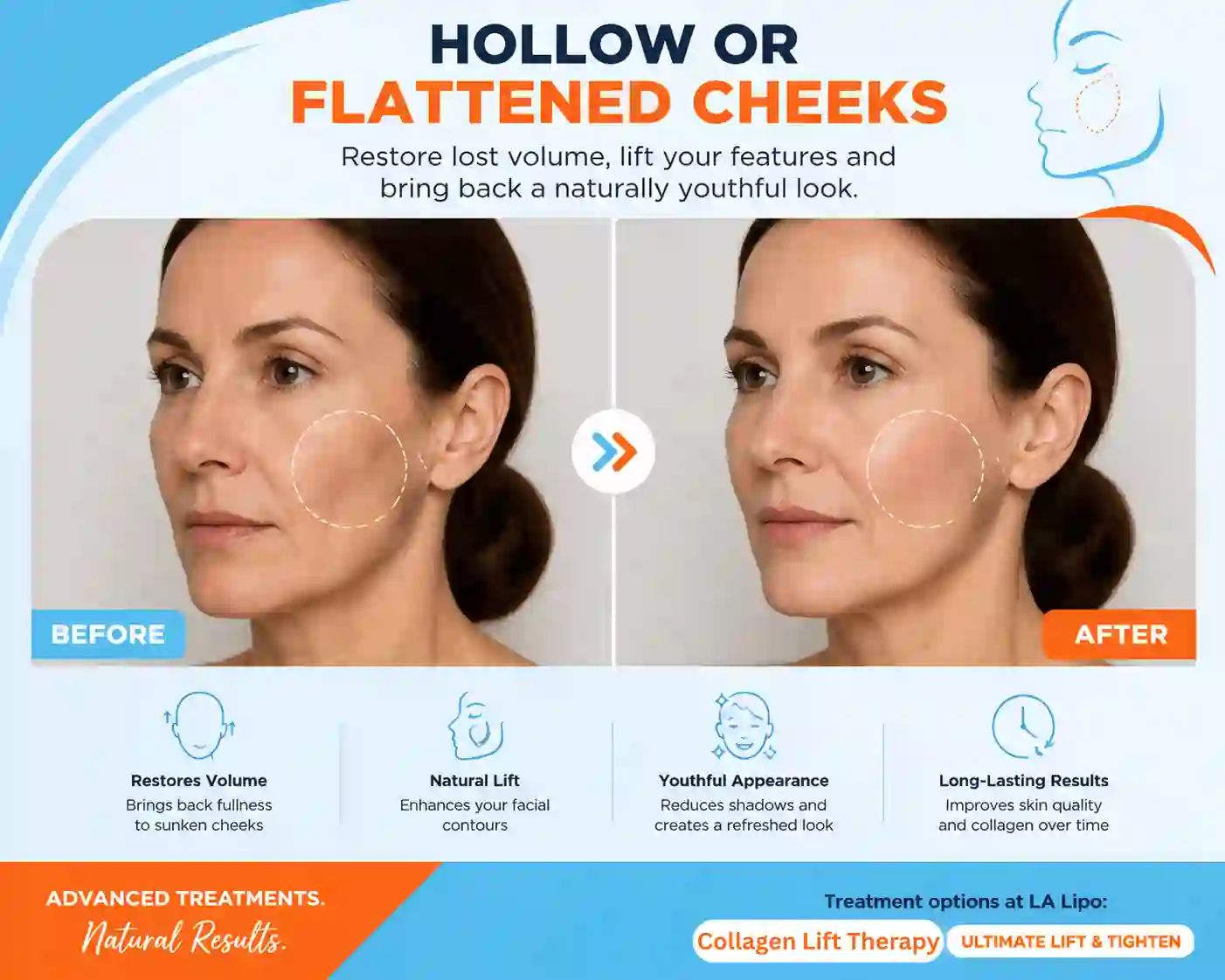 Sign #4: Hollow or Flattened Cheeks Poole