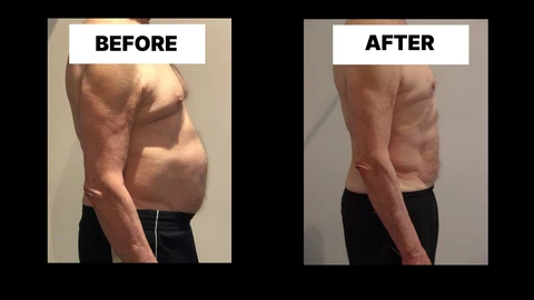 What Symptoms Can Diastasis Recti Cause in Men? Weak Core, Back Pain and Poor Posture Poole